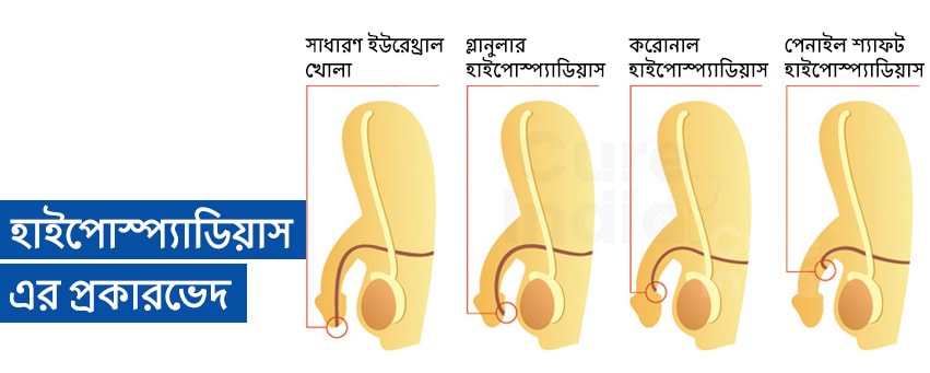 হাইপোস্প্যাডিয়াস (Hypospadias) প্রকার